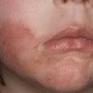 Лечение на себореен дерматит на лицето