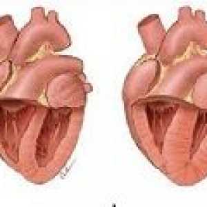Белодробна болест на сърцето: причини, симптоми, лечение