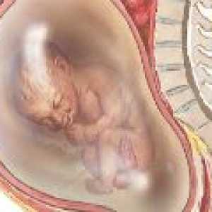 Polyhydramnios време на бременност, причини, последствия