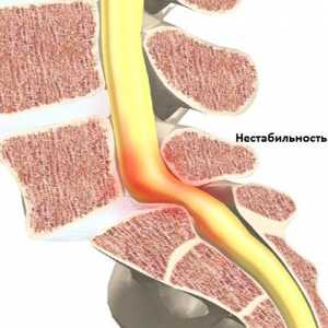 Нестабилността на цервикални симптомите на гръбначния стълб и лечението