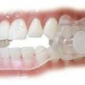 Нощно скърцане със зъби - причинява, лечение