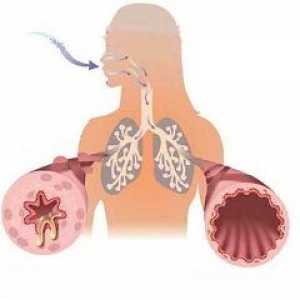 Обструкция на дихателните пътища