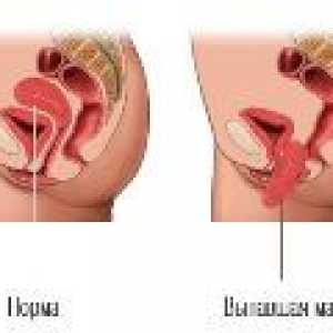 Пропускането на вагиналните стени, причините, как да се лекува?