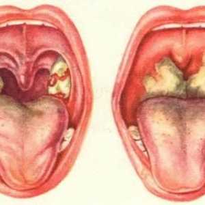 Стрептокок в гърлото - симптоми и лечение на остър фарингит