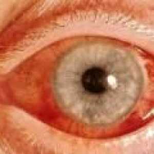 Глаукома с отворен ъгъл: симптоми и лечение