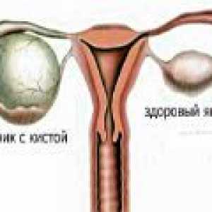 Parovarian киста на яйчника - причини, симптоми, лечение