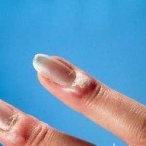Паронихия (инфекция на ноктите) - причини, симптоми и лечение