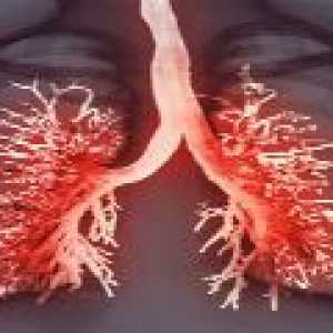 Плеврит белите дробове - симптомите и лечение на плеврит