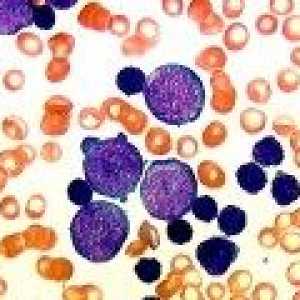 Повишена лимфоцитите в кръвта на възрастен, дете, причина
