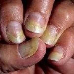 Псориазисът на ноктите на лечение на ръцете и краката
