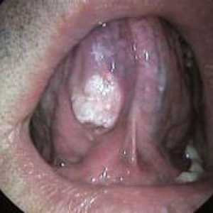 Рак на езика