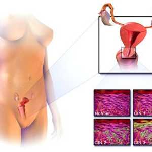 Ракът на маточната шийка: Признаци и симптоми