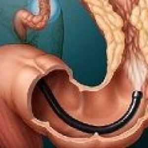 Сигмоидна рак на дебелото черво: причини, симптоми, лечение
