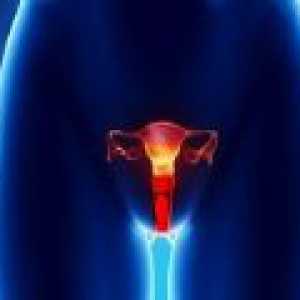 Рак на влагалището при жените - причини, диагностика, лечение