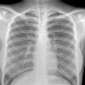 Рентгенография на гръден кош: показания и противопоказания