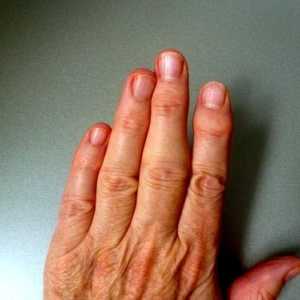 Ревматоиден артрит на пръстите, първите симптоми