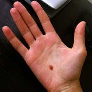 Mole върху дланта на ръката си: какво означава