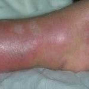 Еризипел крака - симптоми, лечение