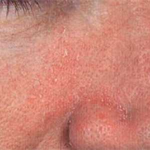 Себореен дерматит (екзема маслен) лицето: причинява, лечение и профилактика