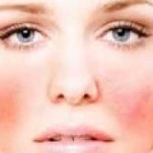Симптоми и лечение на алергии към лицето
