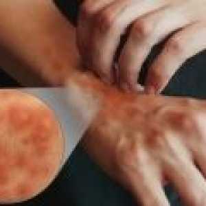 Симптомите и лечението на атопичен дерматит