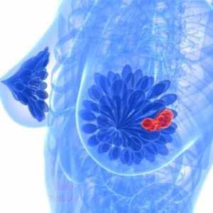 Симптомите и лечението на кисти на гърдата
