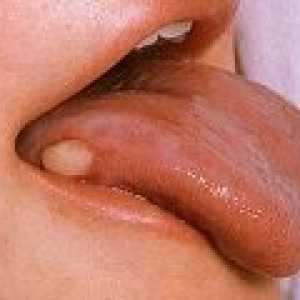 Симптомите на рак на езика