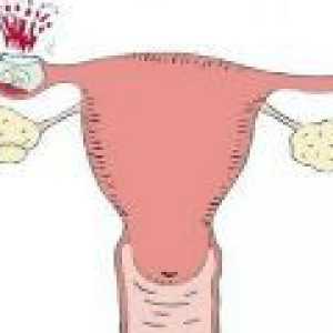 Симптомите на извънматочна бременност в ранна бременност