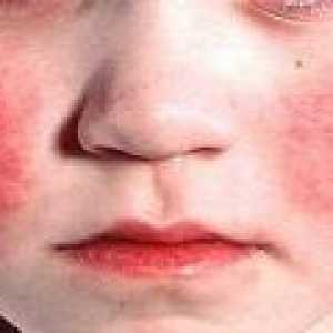 Синдром на Кавазаки при деца: Предизвиква, диагностика, лечение