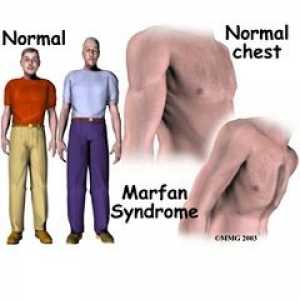 Синдром на Марфан