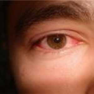 Суха синдром око - причини, симптоми, лечение