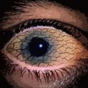 Синдром на сухото око
