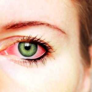 Методи за лечение на конюнктивит око