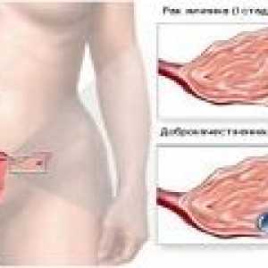 Етап рак на яйчниците при жените
