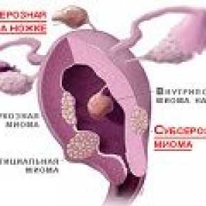 Подсерозни миома на матката - причини, симптоми, лечение