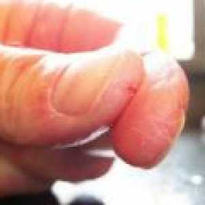 Напукана кожа на ръцете - причинява, лечение