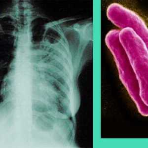 Туберкулоза - Симптоми и признаци на