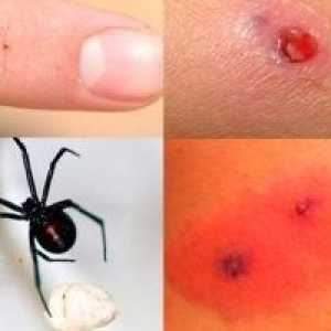 Ухапвания от паяк - симптоми, лечение