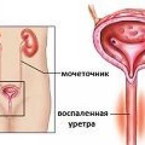 Уретрит при жените - причини, симптоми, лечение