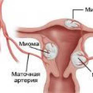 Нодуларна миома на матката - причини, симптоми, лечение