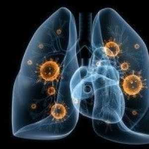 Вирусна пневмония - причини, симптоми, диагностика и лечение