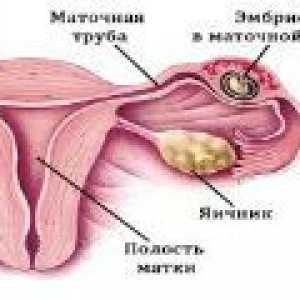 Извънматочна бременност: симптоми, признаци, лечение
