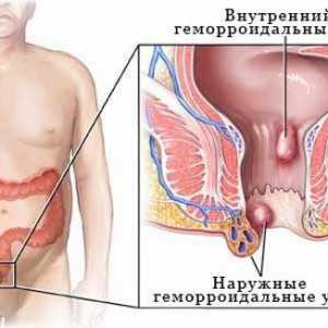 Вътрешни хемороиди - симптоми