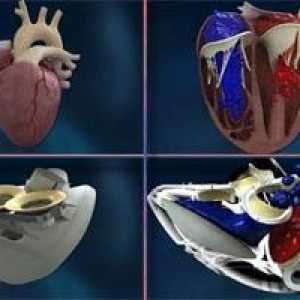 Френската първа имплантира изкуствена сърдечна