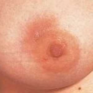 Възпаление на гърдата при жените