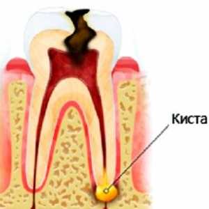 Възможно ли е да се излекува стоматологични кисти, без да сваляте
