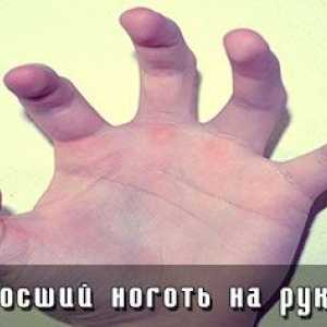 Врастнали нокти на ръцете