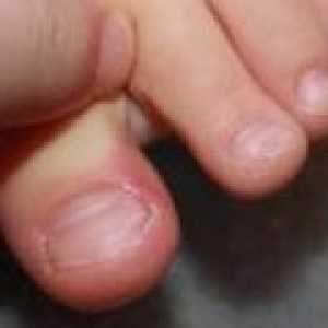 Врастнали нокти - причини, симптоми и лечение