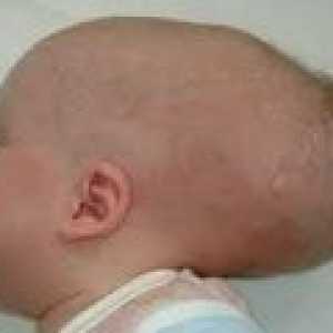 Вродена хидроцефалия при бебето: причини, симптоми, лечение
