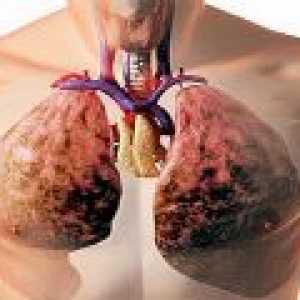 Течност в белите дробове причини, симптоми, лечение